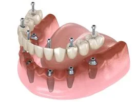 Illustration of an All-on-4 fixed full-arch restoration